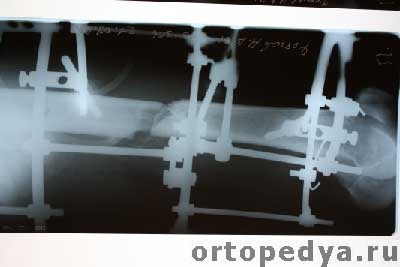 Рентгенограмма правого бедра в аппарате Илизарова