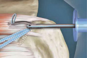 Лечение разрыва ротаторной манжеты плеча