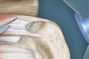 Лечение разрыва ротаторной манжеты плеча