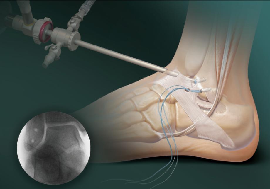 Артроскопические технологии восстановления связочного аппарата голеностопного сустава