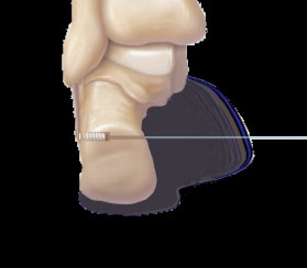 Реконструкция голеностопного сустава