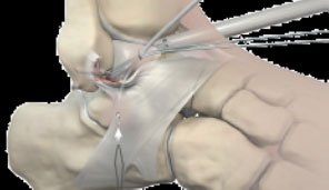 Артроскопическая пластика связки голеностопного сустава