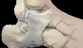 Артроскопическая пластика связки голеностопного сустава